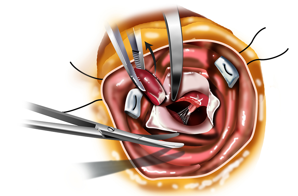 Cut-away view of the heart demonstrating two views of myectomy resection
